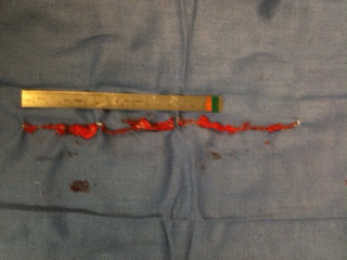 TVT Sling Removed