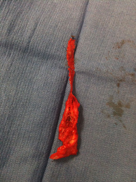Removed Apogee Mesh