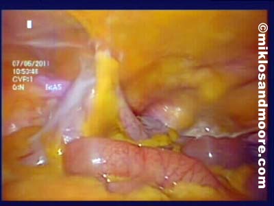 Sigmoid Colon pulled up to the Abdominal Wall