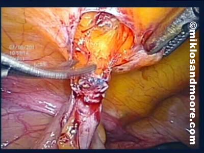 Cutting the mesh away from the Abdominal Wall