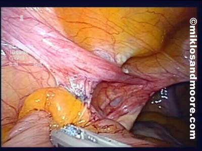 Cutting the other side of the bowel and mesh away from the pelvic sidewall