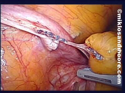 Picture of the free'd up bowel with the old TVT sling going