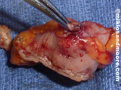 Picture of the free'd up bowel with the old TVT sling going