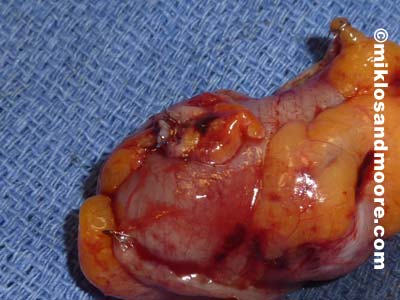 Picture of the free'd up bowel with the old TVT sling going