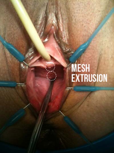 Mesh Extrusion