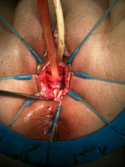 Dissection of the mesh from the bladder