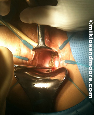 Sacral Colpopexy Reconstruction