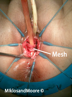 Picture 4: Picture of the released bowel with the old TVT sling going through and through the bowel. This area of bowel had to be removed and resected.
