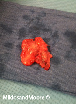Picture 5 & 6: Pictures of the removed piece of bowel with the TVT mesh penetration.
