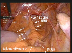  Mesh covered with peritoneum (the skin lining the abdominal cavity).