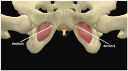  The mesh is seen in the middle of the picture  and has been dissected off of the tailbone.