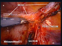 Figure 5 - The mesh is dissected away from neighboring structures