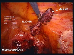 Figure 6 - The mesh is dissected away from the sacrum i.e. tailbone