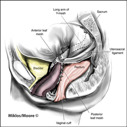 Normal Sacralcolpopexy