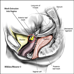 Mesh Extrusion in Vagina - Colpopexy