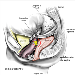 Mesh Extrusion into Vaginal Skin