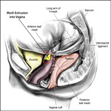 Vaginal Mesh Extrusion / Visible Mesh