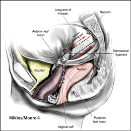 Vaginal and adbominal pain from colopopexy complications