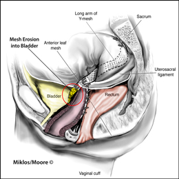 Mesh Erosion in Bladder