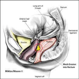 Mesh erosion in rectum