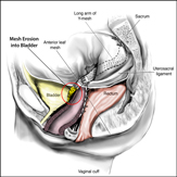 Mesh Erosion in Bladder or Rectum