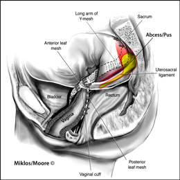 Abscess of Mesh