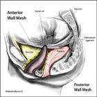 Vaginal Mesh Kits Complications