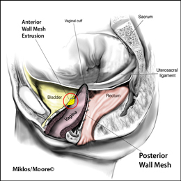 Normal Positioned Mesh