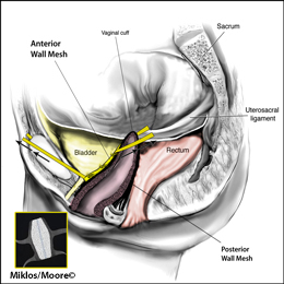 Anterior Mesh Arms