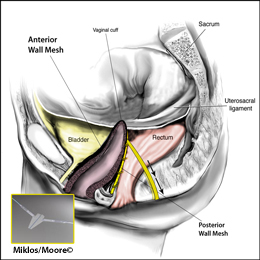 Posterior Mesh Arms