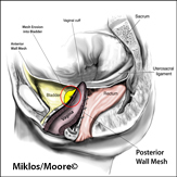 Mesh erosion in bladder