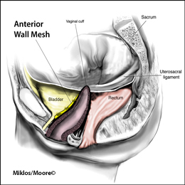 Normal Anterior Wall Mesh