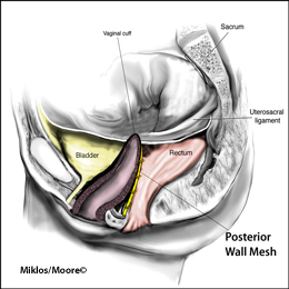 Normal Posterior Wall Mesh