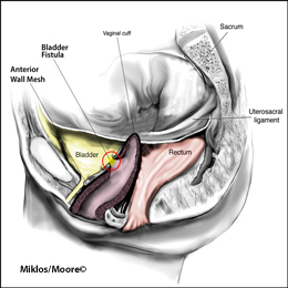 Bladder Fistula