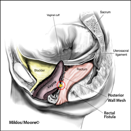 Rectal Fistula