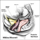 Fistula Formation