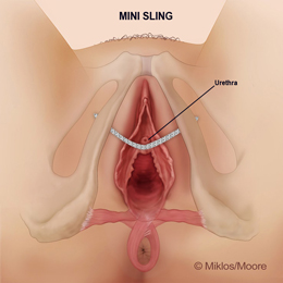 Normal Mini Sling