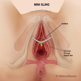 Mesh extrusion through vaginal skin