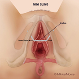 Groin and buttocks pain