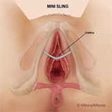 Mesh erosion in bladder