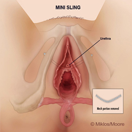 Portion of mesh removed to relieve tension