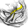 Sacralcolpopexy Mesh Complications