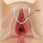 TOT Sling Complications