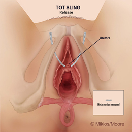 Portion of mesh removed to relieve tension