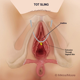 Vaginal mesh extrusioin / visible mesh