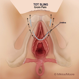 Tension causing groin pain