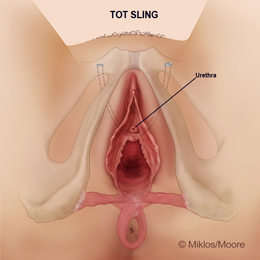 Removal of mesh to relieve tension / pain