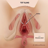 Average Surgeon TOT Sling Removal