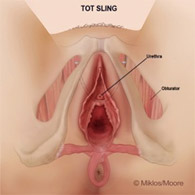 Drs. Miklos & Moore TOT removal for bilateral groin pain