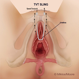 Upward tension causing abdominal pain